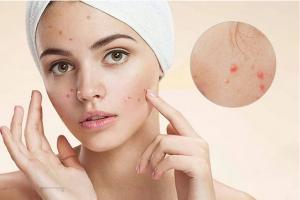 Kem trị mụn sưng đỏ nhanh và tốt nhất hiện nay