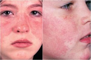Lưu ý quan trọng nhất về bệnh lupus ban đỏ