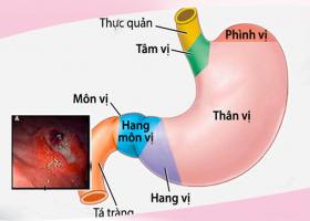 Triệu chứng viêm hang vị dạ dày