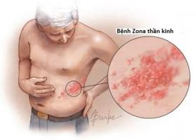 Lưu ý quan trọng nhất về bệnh Zona thần kinh