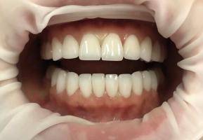 Địa chỉ bọc răng sứ uy tín nhất Quảng Bình