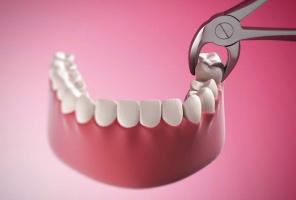 Địa chỉ nhổ răng khôn uy tín, an toàn nhất Long An