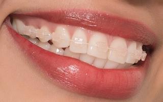 Nha khoa niềng răng mắc cài sứ dây trong uy tín nhất Hà Nội