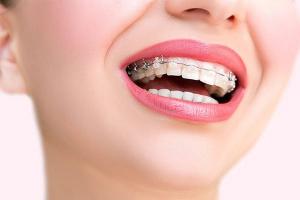 Nha khoa niềng răng mắc cài sứ, dây trong uy tín nhất tỉnh Khánh Hòa