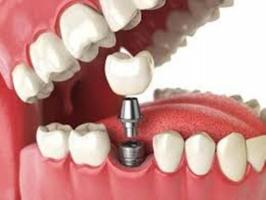 Địa chỉ trồng răng implant tốt nhất tại Đà Nẵng