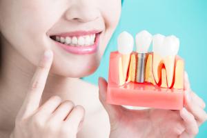 Nha khoa trồng răng implant uy tín nhất quận Tân Bình, TP. HCM