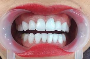 Địa chỉ bọc răng sứ uy tín nhất Quảng Nam