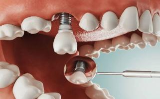 Nha khoa trồng răng implant uy tín nhất quận Tân Phú, TP. HCM