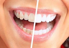 Địa chỉ bọc răng sứ uy tín nhất tỉnh Quảng Ngãi