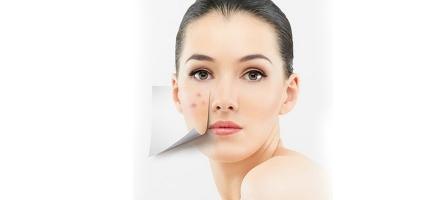 Loại thực phẩm thường gặp nhất gây nên mụn trứng cá