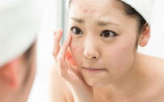 Phòng khám trị mụn uy tín tại TP.HCM