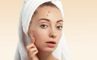 Sản phẩm chăm sóc da dành cho da mụn tốt nhất hiện nay