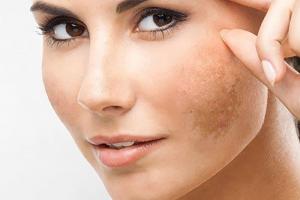 Sản phẩm trị nám da mặt hiệu quả nhất