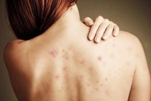 Serum trị mụn lưng tốt nhất hiện nay