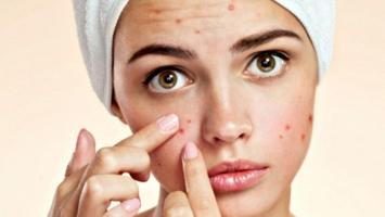 Spa trị mụn hiệu quả nhất tỉnh Hải Dương