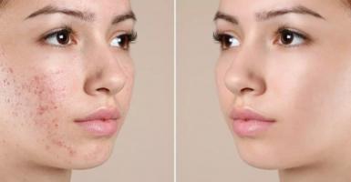 Spa trị mụn hiệu quả nhất ở Quảng Ngãi