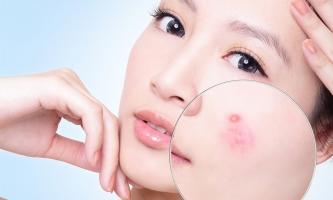 Spa trị mụn hiệu quả nhất thành phố Vinh, Nghệ An