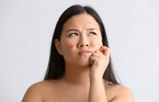 Spa trị mụn uy tín nhất quận Tân Phú, TP. HCM