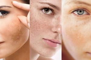 Spa trị nám hiệu quả nhất Quận 5, TP. HCM