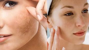 Spa trị nám hiệu quả nhất quận 6, TP. HCM