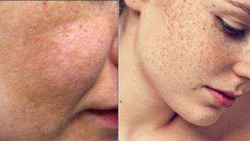 Spa trị nám hiệu quả nhất quận Bình Thạnh, TP. HCM