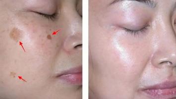 Spa trị nám tốt nhất Bến Tre