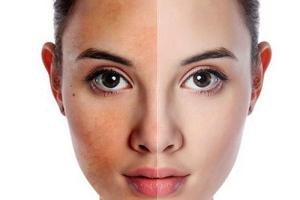 Spa trị nám tốt nhất Vũng Tàu