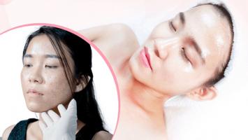Spa trị sẹo rỗ do mụn uy tín nhất tại Cần Thơ
