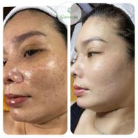 Spa trị nám tốt nhất TP. Rạch Giá, Kiên Giang