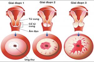 Căn bệnh nguy hiểm nhất đối với phụ nữ