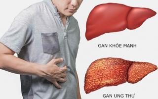 Sản phẩm hỗ trợ điều trị ung thư gan tốt nhất
